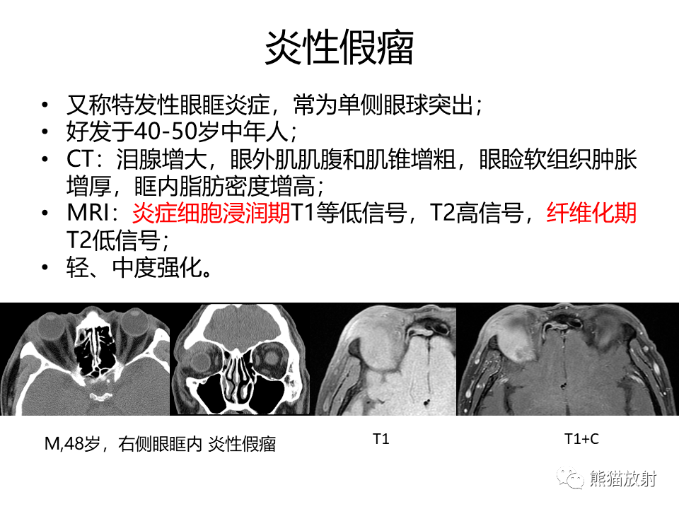 眼眶绿色瘤,淋巴瘤解剖丨颅面颈部(颅面骨,眼眶,腮腺,等)返回搜狐