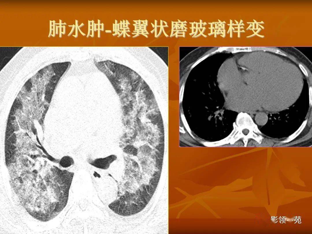 二,增殖性病变 三,纤维化 四,钙化 五,空腔和空洞性病变 六,结节和