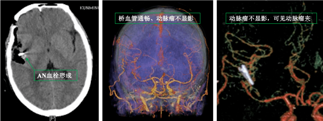 图四:术后ct显示动脉瘤内血栓形式,cta显示桥血管通畅,动脉瘤不显影.