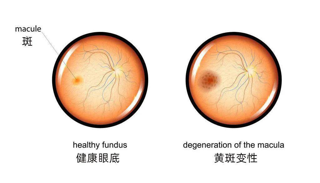 常见的眼底病变有:视网膜脱离,玻璃体混浊,黄斑劈裂,黄斑裂孔,玻璃体