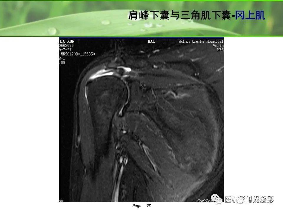 收藏:肩关节mri解剖肩袖损伤诊断技巧