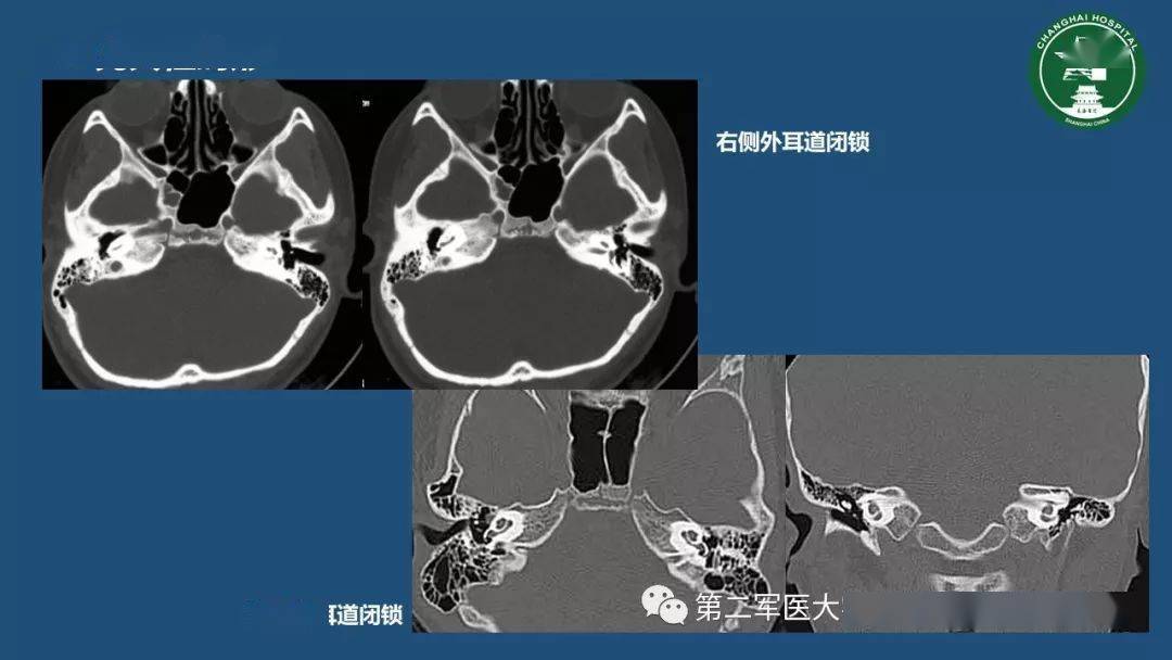 颞骨ct解剖及其常见病变