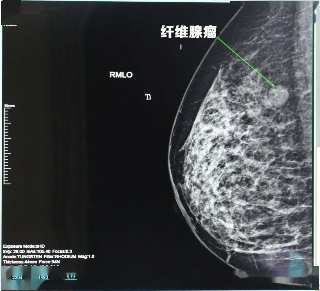 乳腺癌防治月 | 关注乳腺健康-中国家庭报官网