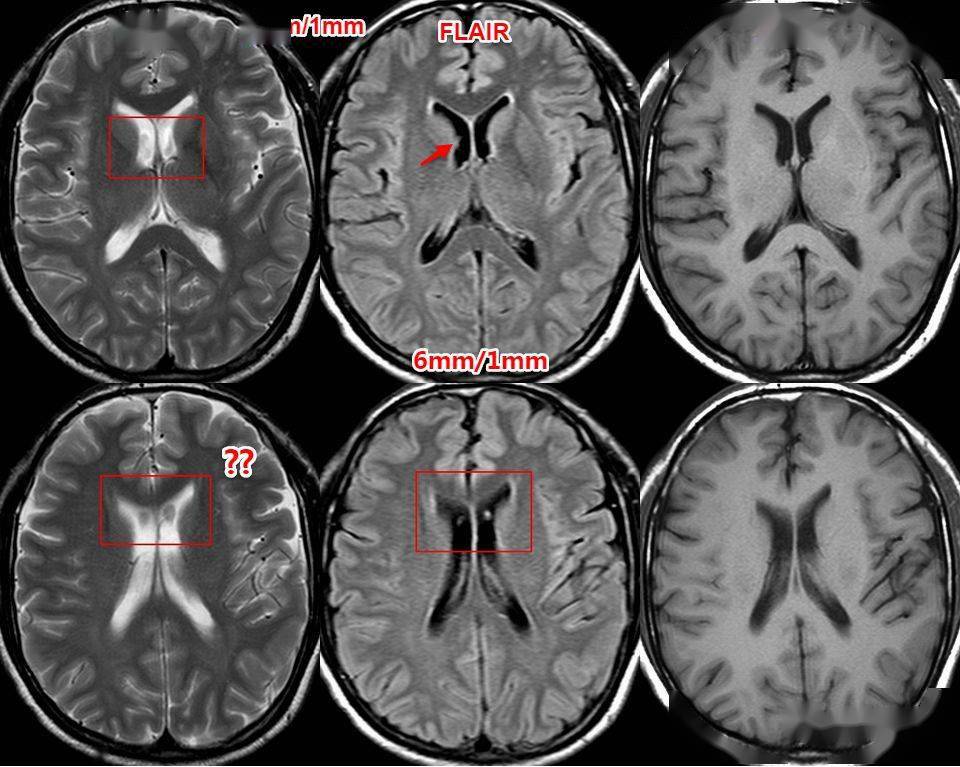 入门必读:头颅mri易误诊影像,赶紧收藏!