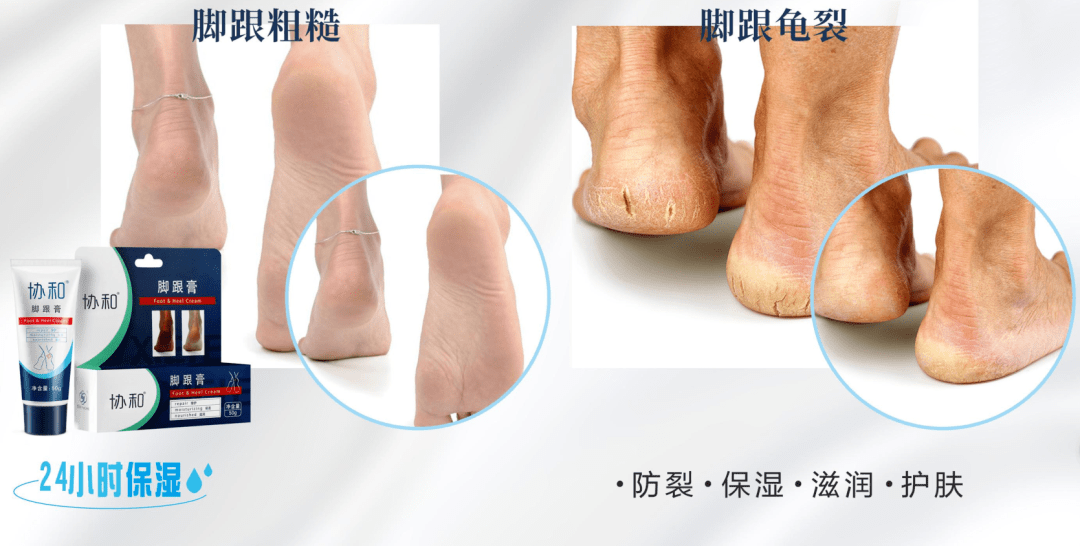 脚跟开裂,老茧,死皮…又疼又丑!用它一抹,双脚嫩滑,实测惊呆了!