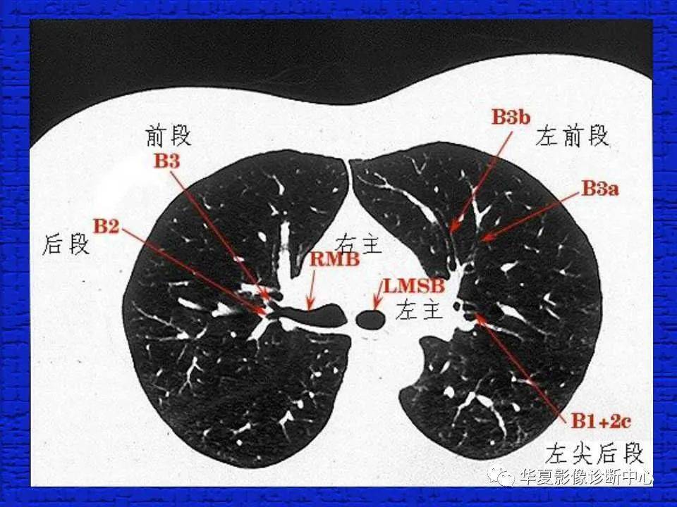 结合解剖谈正常胸部ct读片