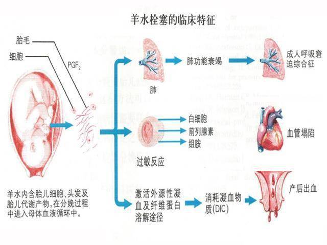 原创害怕羊水栓塞不敢生孩子怎么办?