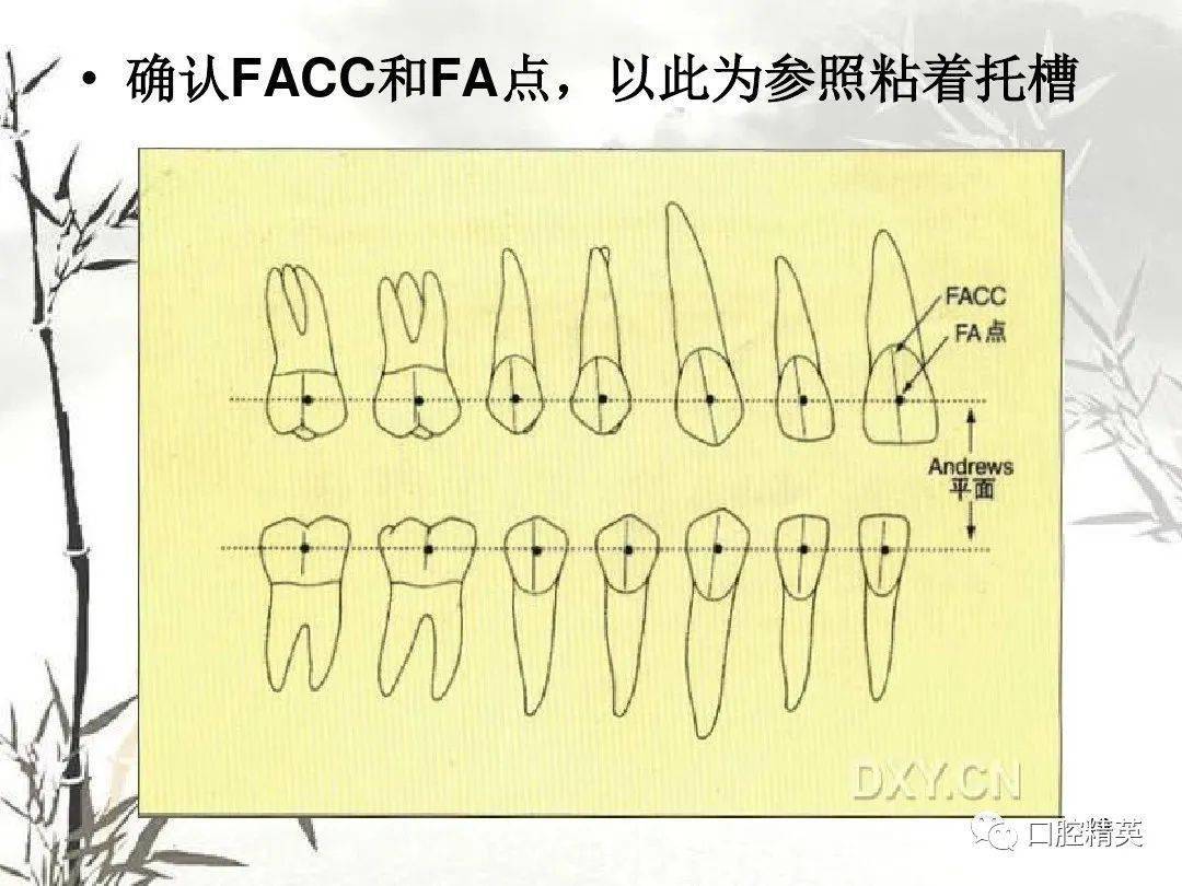 托槽粘接位置