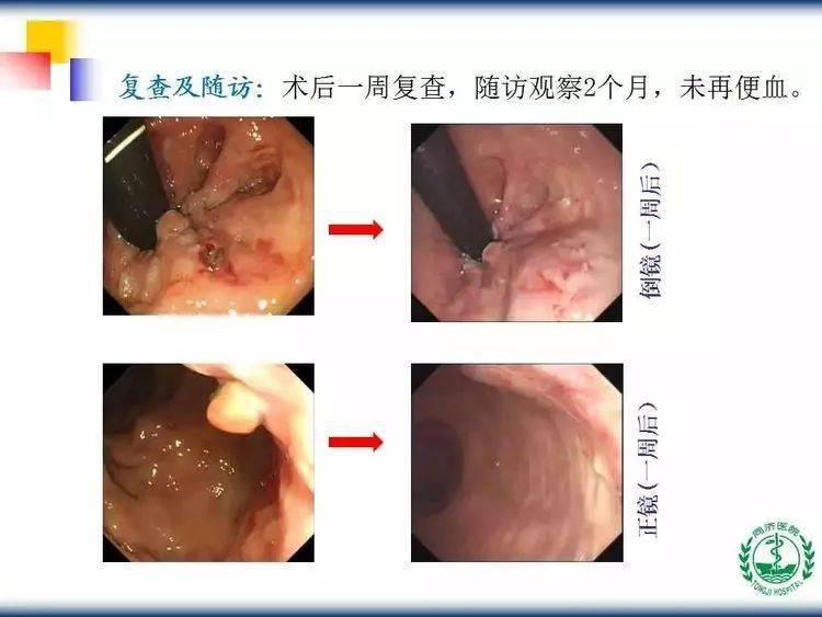 透明帽辅助内镜下硬化术(caes)治疗痔疮
