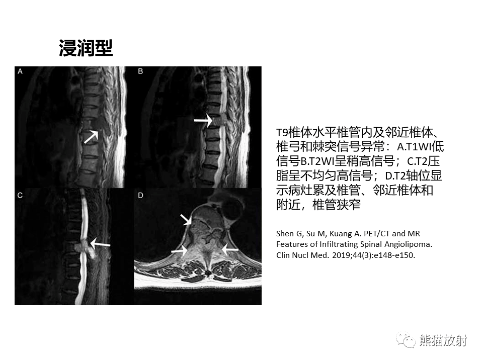 【省立影像读片】椎管内外病变 20.12