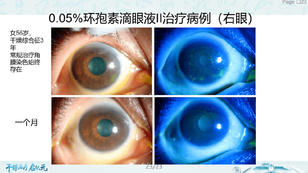 05%环孢素滴眼液(Ⅱ)是否能同时进行?  a:临床上,混合型干眼较多见.