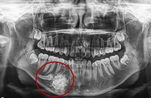 吓人16岁女孩竟长出70多颗小牙牙齿还能长肿瘤