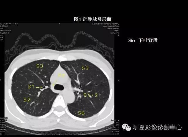 本文来源:华夏影像诊断中心 掌握肺部疾病ct,快速学好肺部感染ct,so