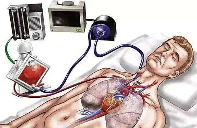人工心肺机,最核心的部分是  膜肺和血泵,分别起  人工肺和人工心的