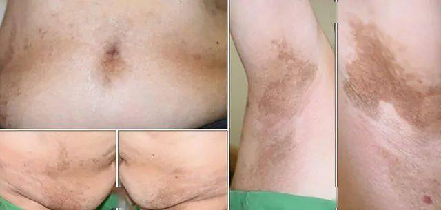 色素沉着斑是什么样子 4e2e5686a62146c0add5a7fc7269bc23.jpeg