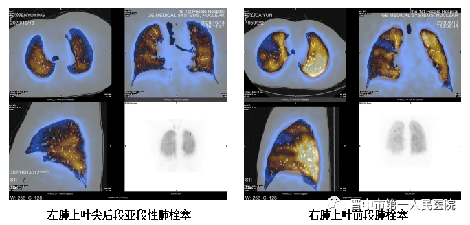 ct临床应用宣传周活动 ——肺栓塞与肺血管疾病的诊治学术交流会成功