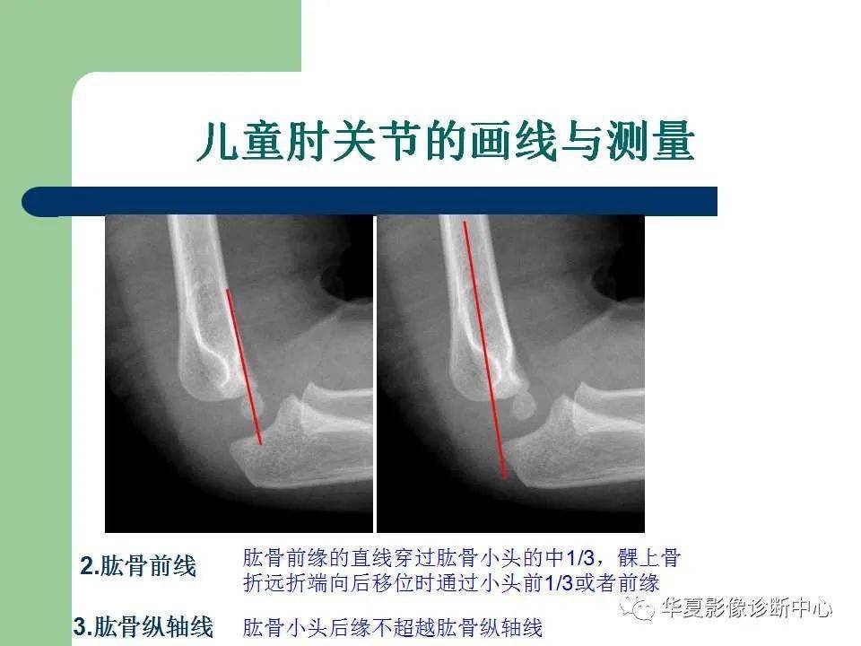 影像基础儿童肘关节损伤x线诊断
