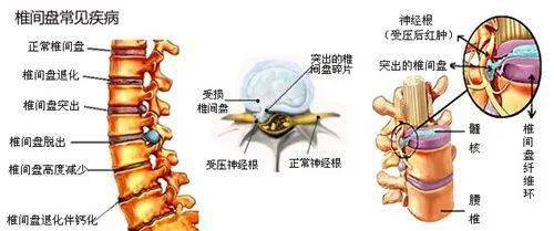 椎间盘退变