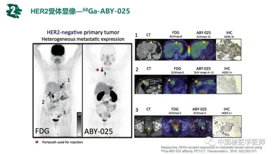 核汇园41期范岩乳腺癌petct应用进展