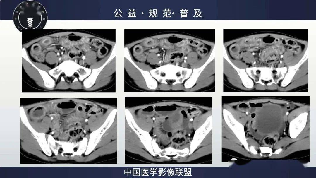结合白细胞和c反应蛋白明显增高,常规考虑克罗恩病,鉴别肠结核,好发回