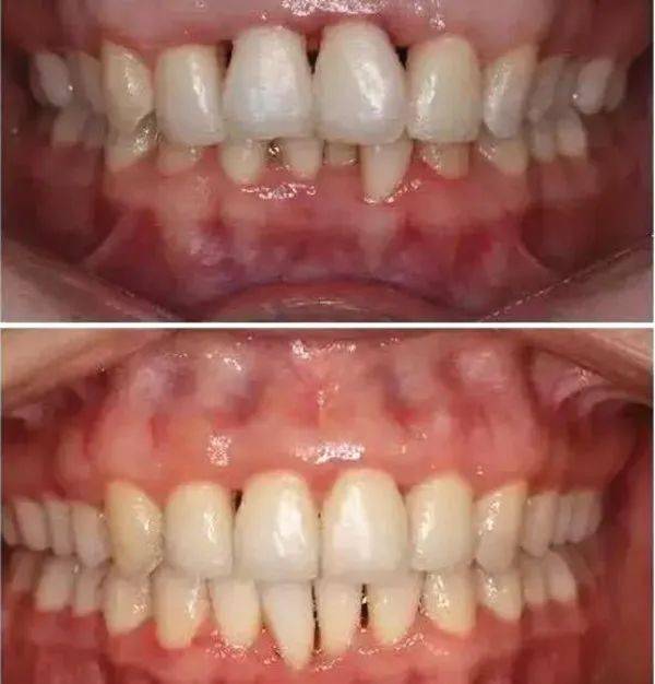 牙齿矫正后出现了黑三角,牙龈萎缩的情况还有救吗?