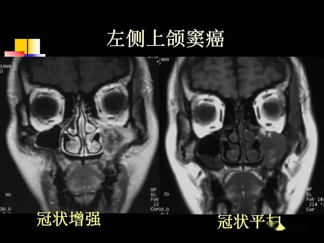 鼻及鼻窦影像解剖及相关疾病影像诊断