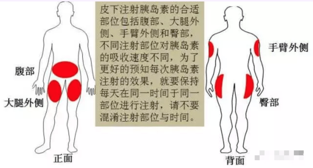 胰岛素分类、应用及注意事项 注射液