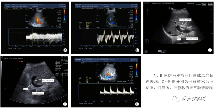 肝移植术后门静脉二维超声表现和血管的正常频谱表现