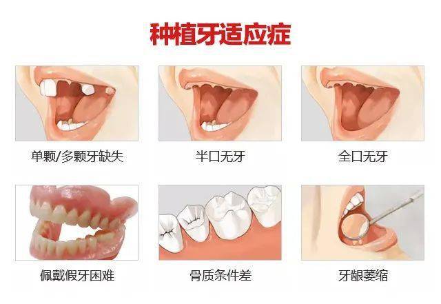 怎么才能让牙齿变牢固 f1fd868ca8a54ce6a18b019ab9c11606.jpeg