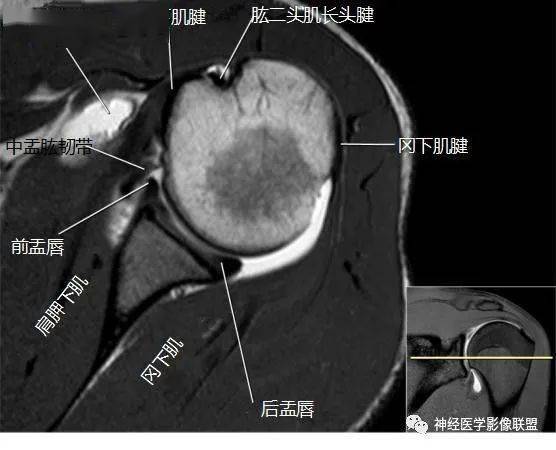 断层解剖 | 肩关节磁共振