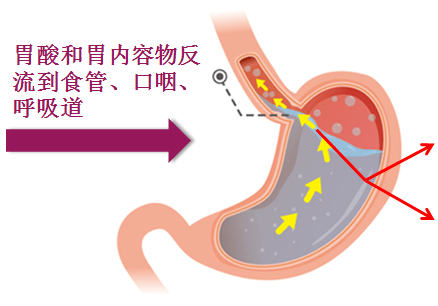 健教丨你了解胃食管反流病吗？