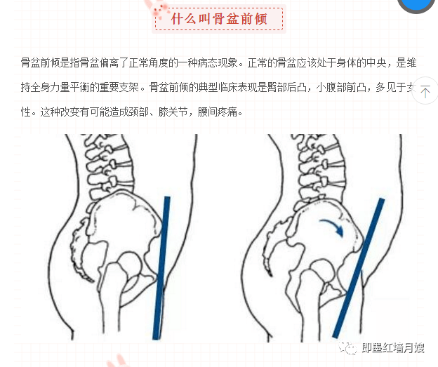 产后前庭突出怎么办