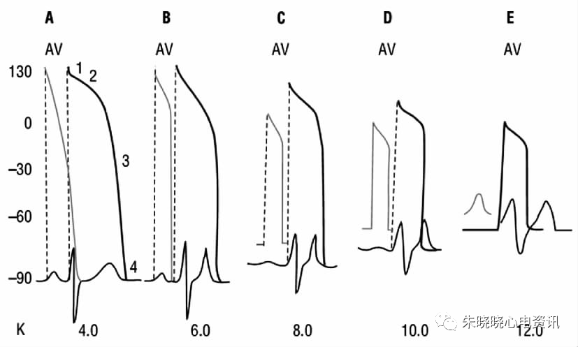高钾血症临床关注的心电图问题
