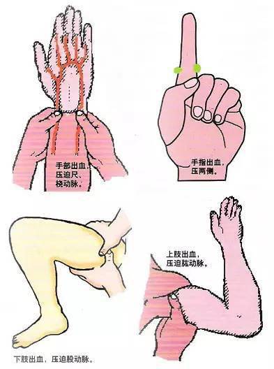 ①指压动脉止血法