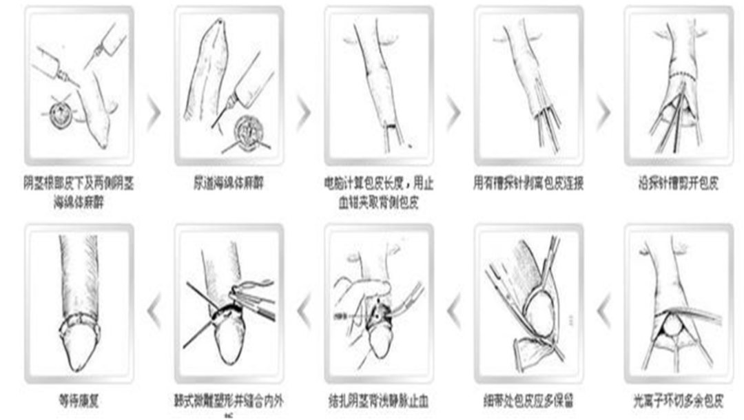 改良包皮环切术,器具辅助包皮手术(商环包皮环切术,包皮环切吻合术