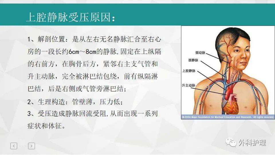 【ppt】1例肺癌合并上腔静脉压迫综合征患者的b超引导下下肢置管护理