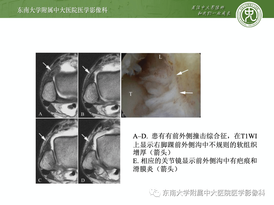踝关节撞击综合征的诊断