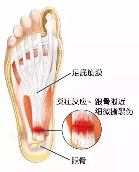 脚底板的痛,你不懂!试试这几招,缓解90%的足跟痛!