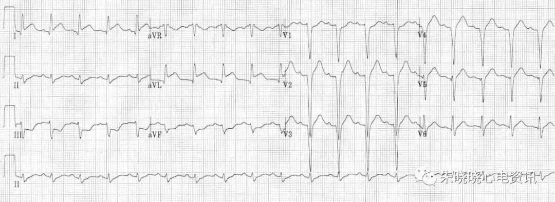 心肌缺血的心电图表现