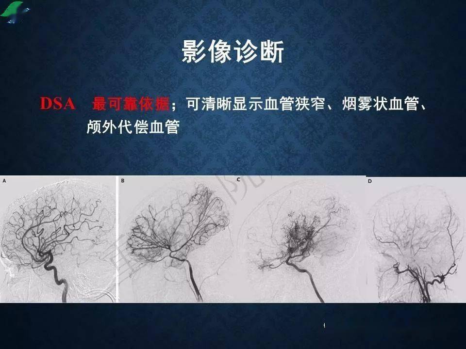 烟雾病的影像学诊断