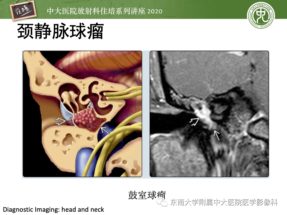 中大放射住培系列讲座头颈部神经源性肿瘤的影像诊断