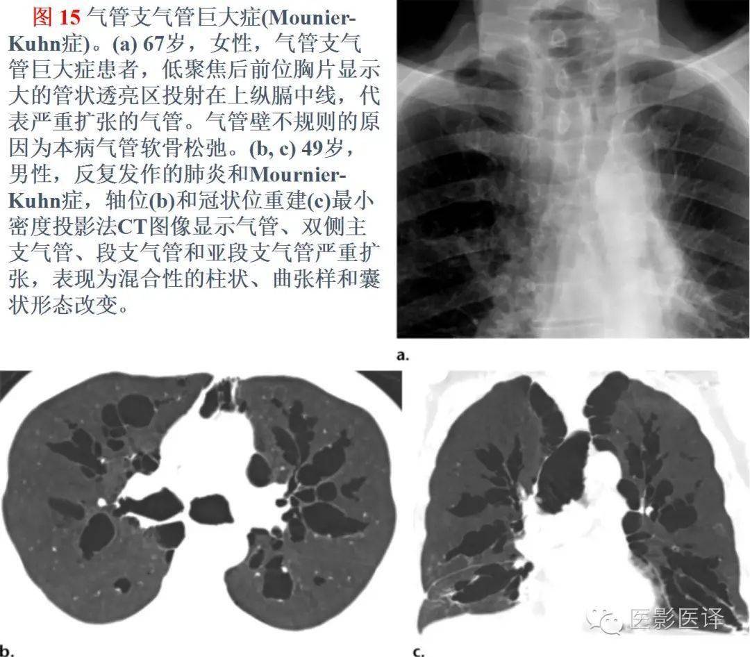 【图文详析】支气管扩张的机制,影像特征和病因