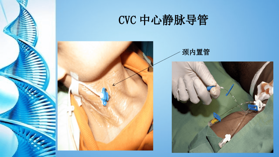 ppt深静脉导管并发症的预防及处理