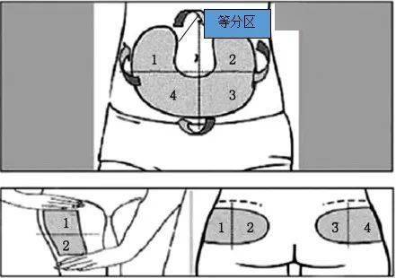 打胰岛素的部位图 7d8829d7ff3041f98639cd8636cfc82e.jpeg