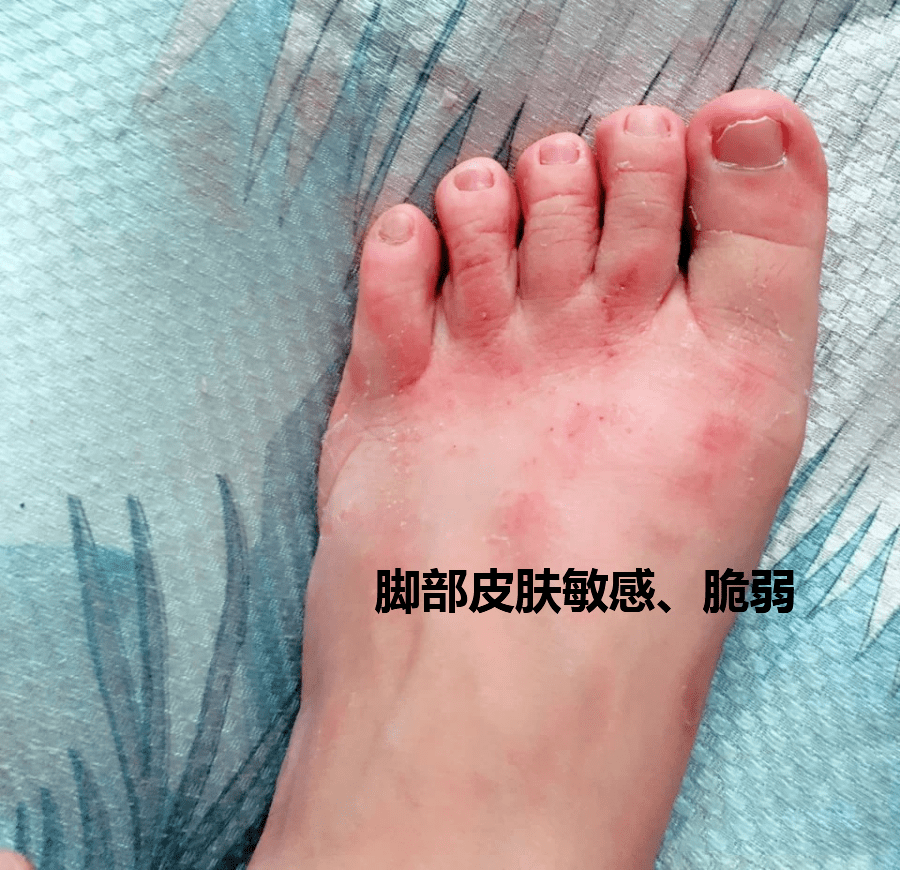 这种足膜敷的时候经常会有烧脚的感觉,用多了渐渐的皮肤也变的越来越