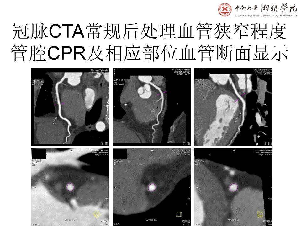 湘雅冠脉cta标准化后处理及规范化报告