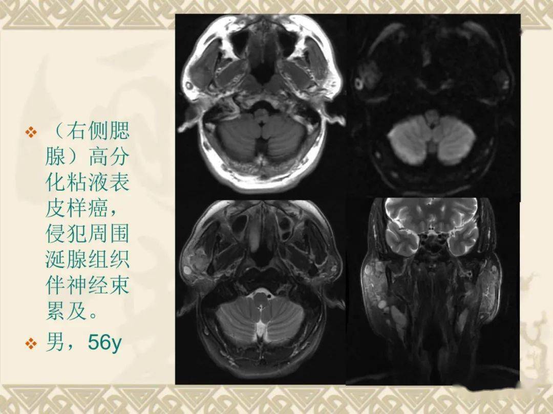 腮腺解剖及病变影像学表现