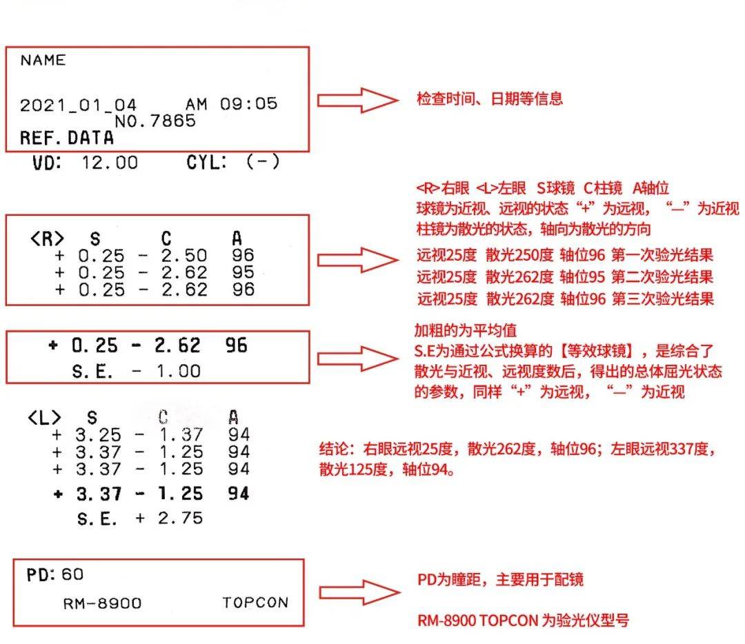验光单上写的都是啥主要看懂这几项就够了