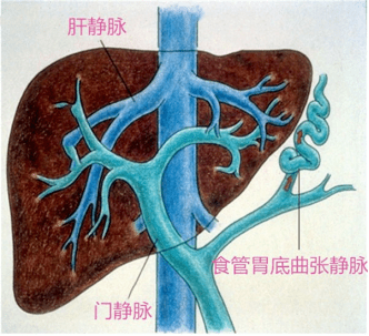 这个病肝硬化患者需重视!_门静脉