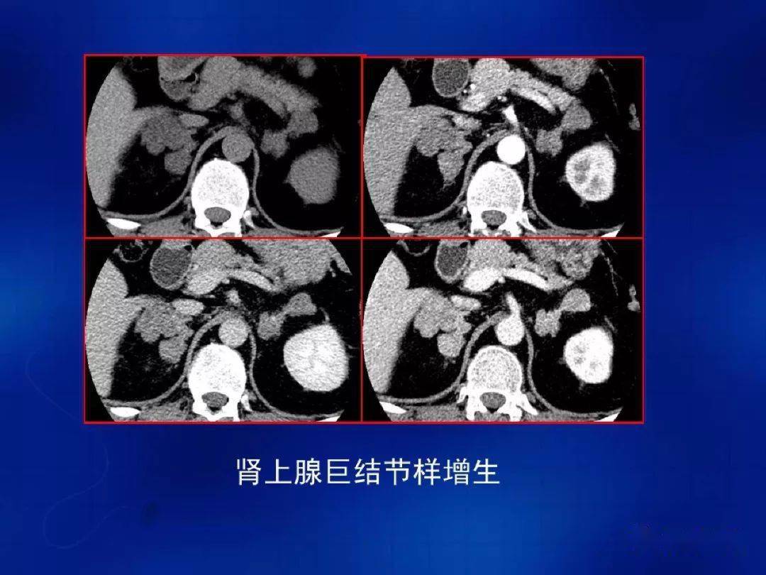 肾上腺肿瘤及瘤样病变的影像诊断